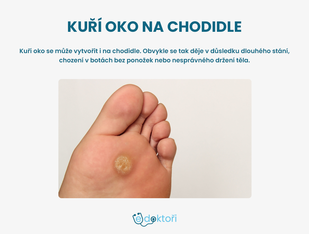 Kuří oko na chodidle