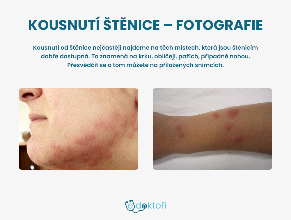 Kousnutí štěnice na obličeji a ruce