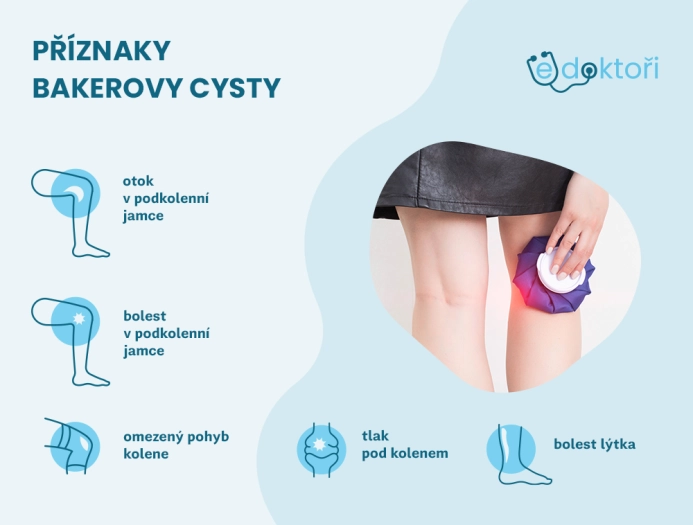 Příznaky Bakerovy cysty