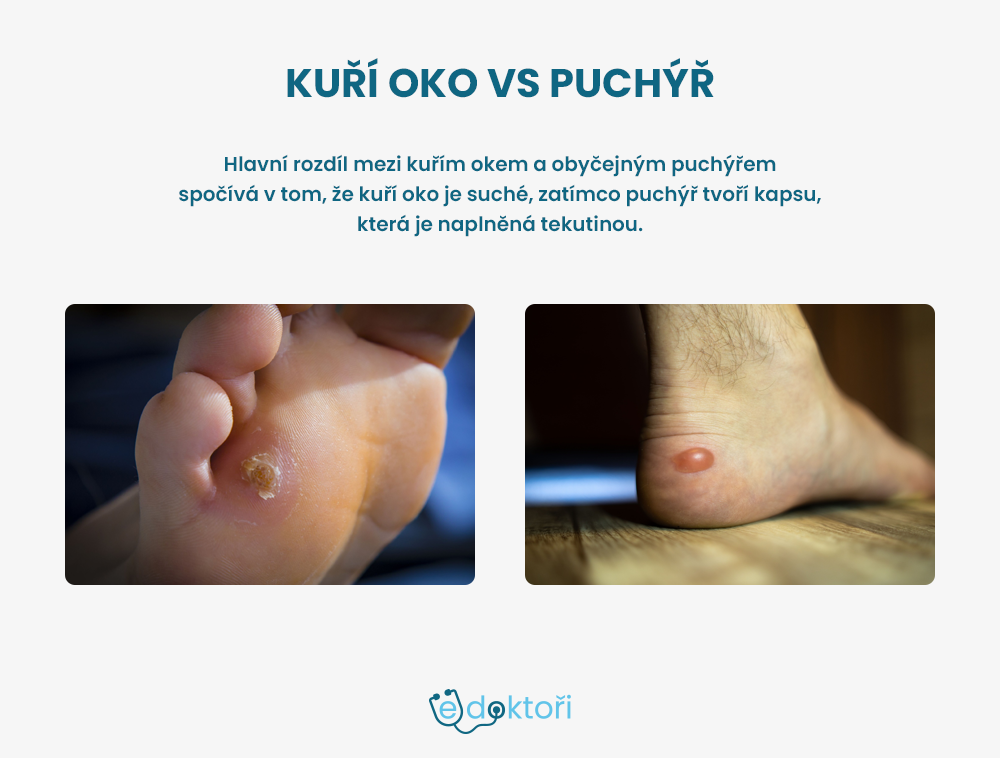 Kuří oko vs puchýř