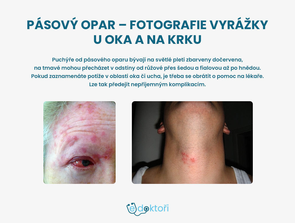 Pásový opar u oka a na krku - fotografie