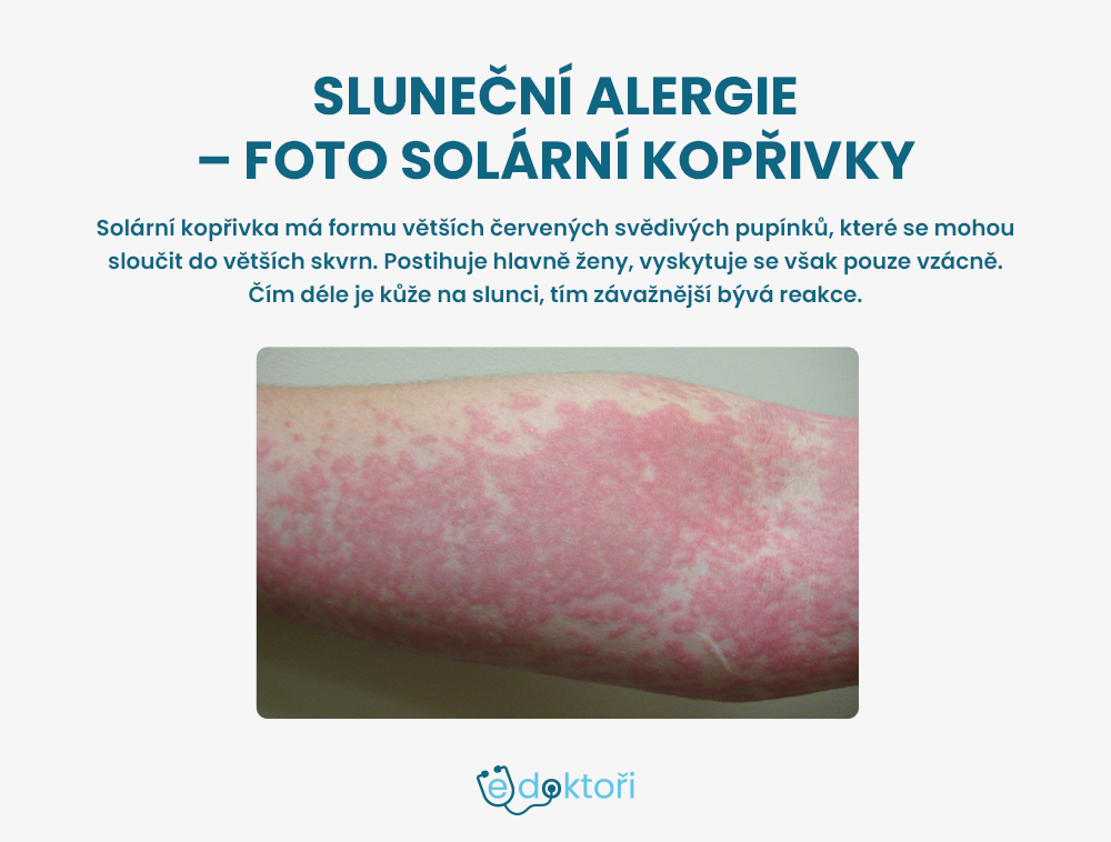 sluneční alergie foto - solární kopřivka