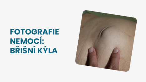 Břišní kýla fotografie