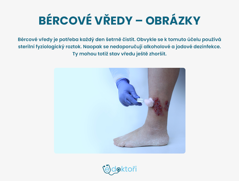 Léčba bércových vředů